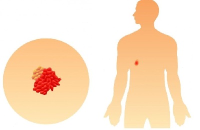 Раковая опухоль