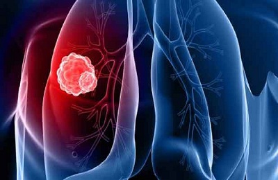 Раковая опухоль