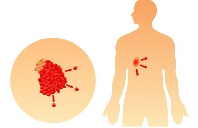 Раковая опухоль