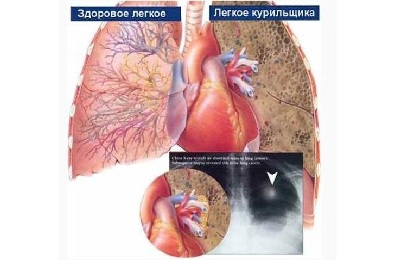 Вред сигарет