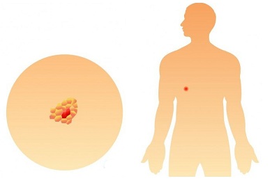 Раковая опухоль