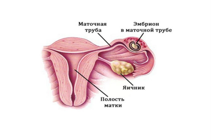Внематочная беременность