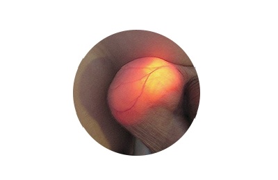 Диафаноскопия