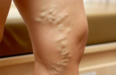 Поражение ног