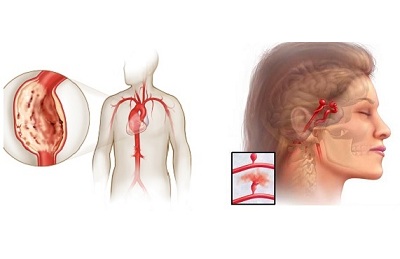 Нарушение сосудов