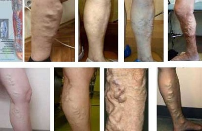 Поражение ног