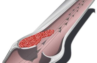 Закупорка вен