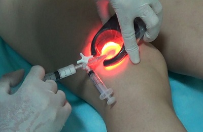 Лечение вен