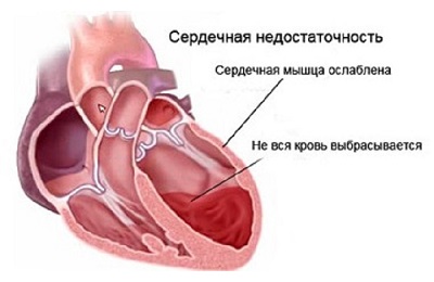 Больное сердце