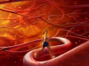 Атеросклероз