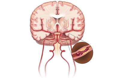 Повреждение сосуда