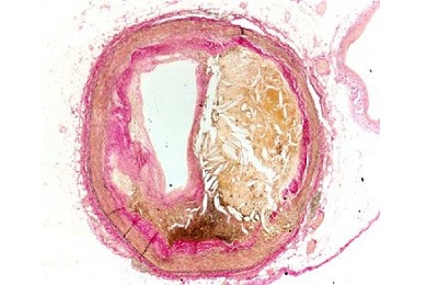 Отложение в сосуде
