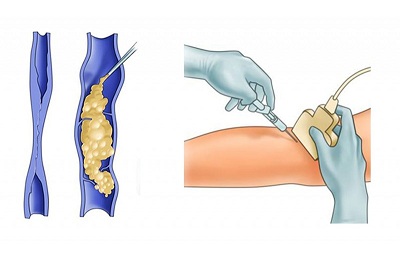 Проведение процедуры