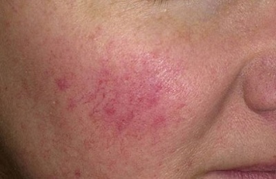 Поражение кожи