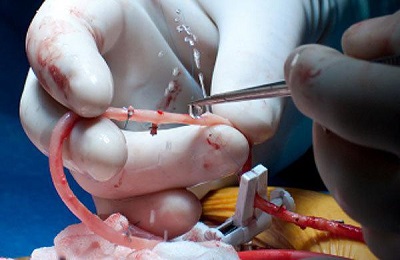 Пришивание артерии