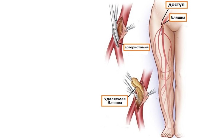 Эндартерэктомия