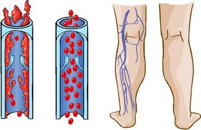 Застой венозной крови