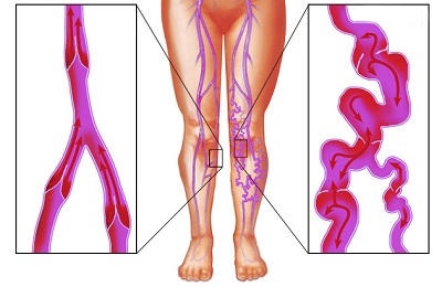 Поражение ног