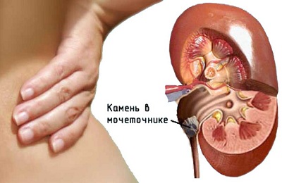 Мочекаменная болезнь