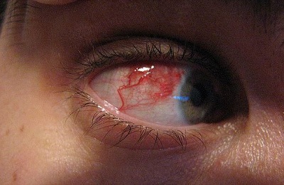 Больной глаз