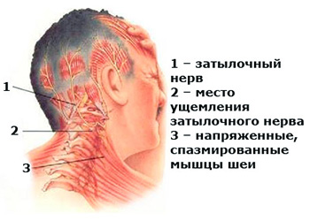 Невралгия затылочного нерва