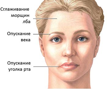 Последствия неврита