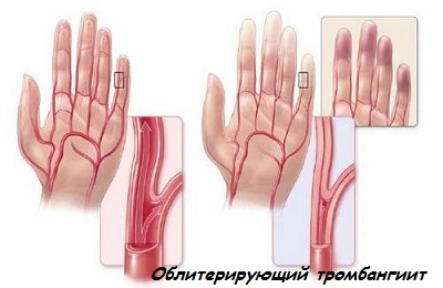 Облитерирующий тромбангиит