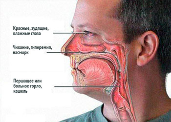 Отек Квинке