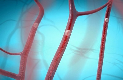 Тромбы в венах