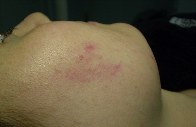 Рубец на коже