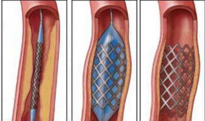 Шунтирование