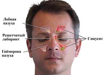 Схема синусита