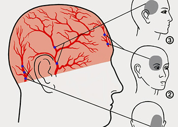 Сосудистая форма