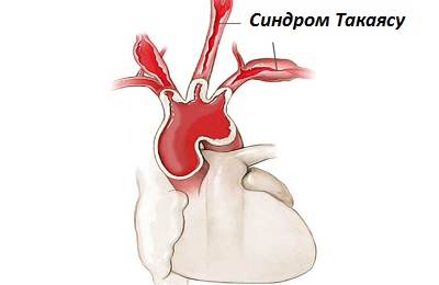 Синдром Такаясу