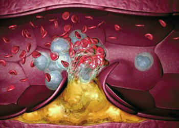 Тромбоэмболия