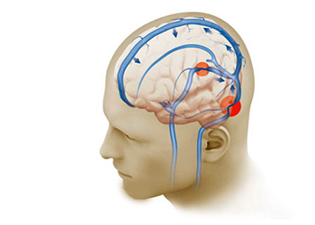 Расширение венозного русла