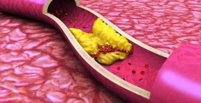 Холестерин в сосудах