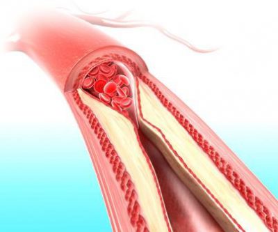 Холестерин в сосудах