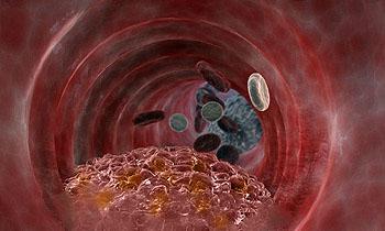 Атеросклероз