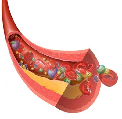 Забитый сосуд