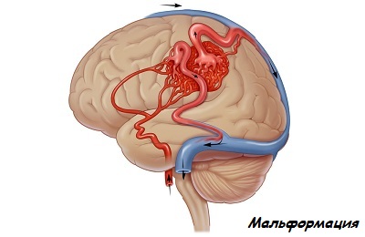 Мальформации