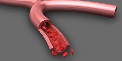 Болезни сосудов