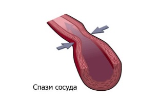 Спазм