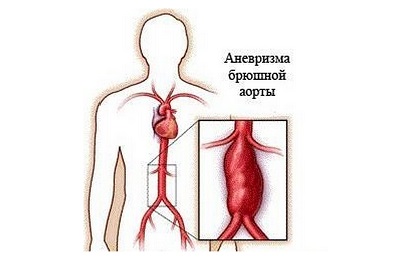 Аневризма аорты