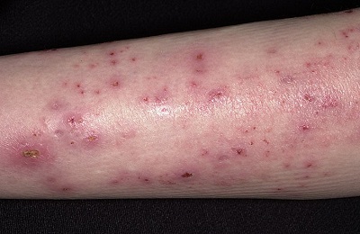 Поражение кожи