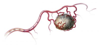 Образования на сосудах