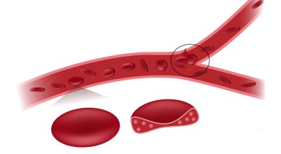 Закупорка сосудов