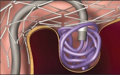 Операция на сосудах