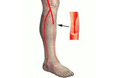 Болезнь вен