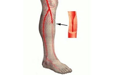 Спазм сосуда